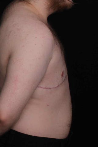 FTM Top Surgery Before & After Gallery - Patient 123340 - Image 6