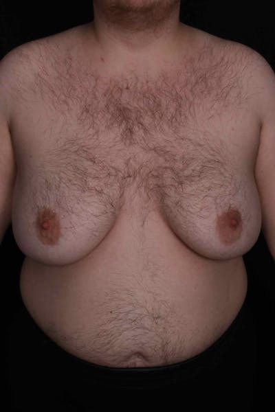 FTM Top Surgery Before & After Gallery - Patient 123340 - Image 1