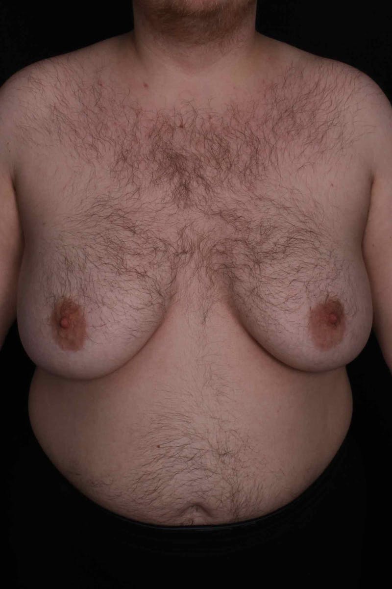 FTM Top Surgery Before & After Gallery - Patient 123340 - Image 1