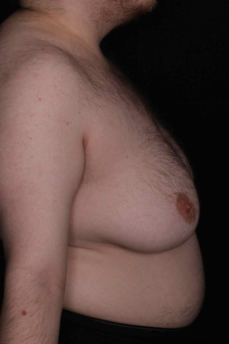 FTM Top Surgery Before & After Gallery - Patient 123340 - Image 5