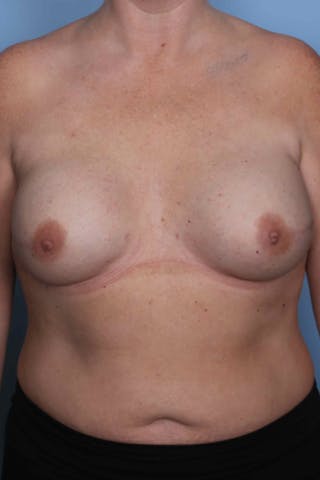 Breast Reconstruction Before & After Gallery - Patient 197483 - Image 2