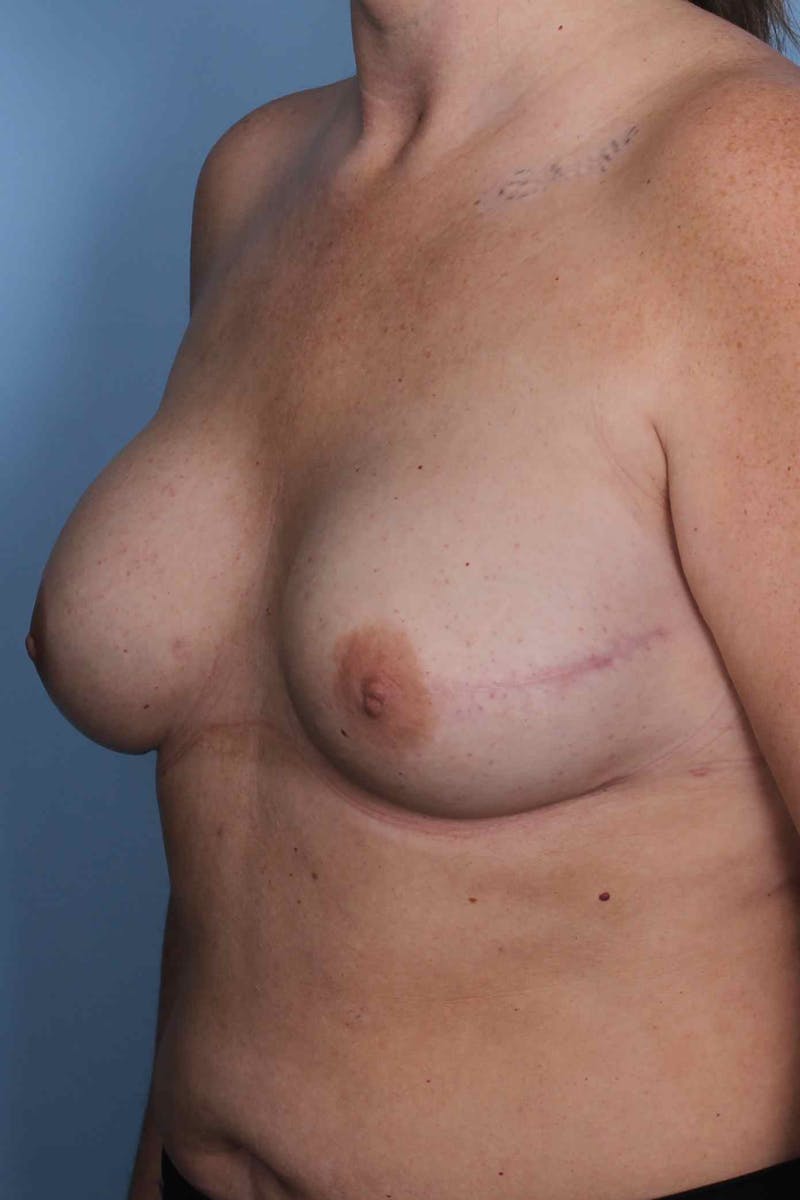 Breast Reconstruction Before & After Gallery - Patient 197483 - Image 4