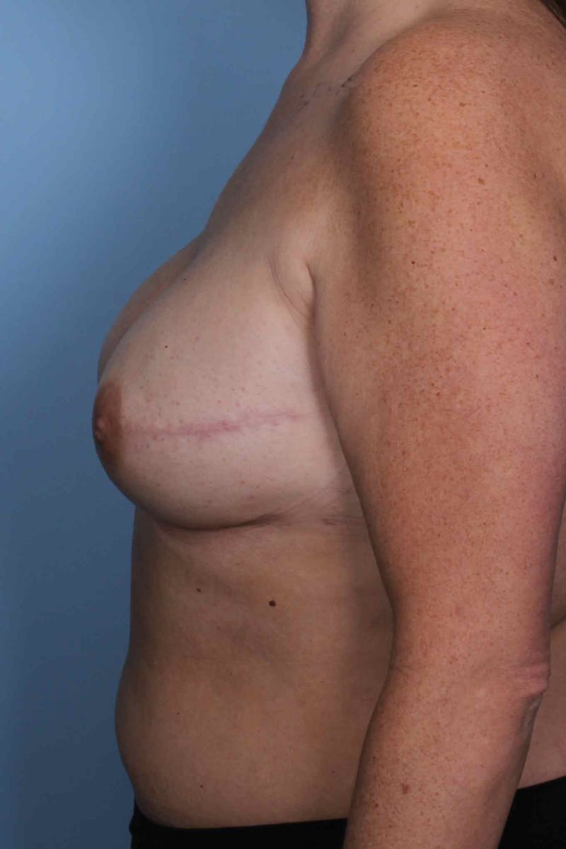 Breast Reconstruction Before & After Gallery - Patient 197483 - Image 6