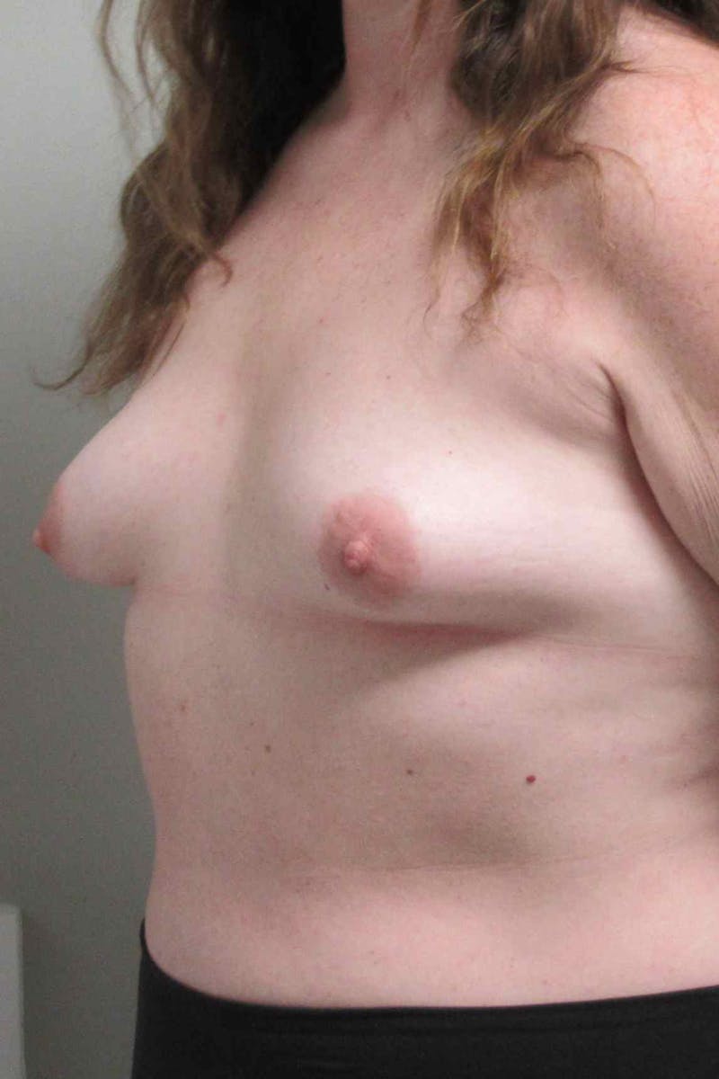 Breast Reconstruction Before & After Gallery - Patient 197483 - Image 3