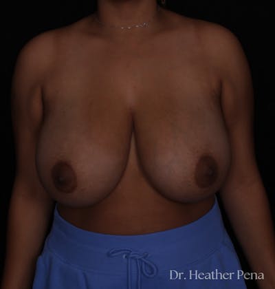 Breast Reduction Before & After Gallery - Patient 334837 - Image 1