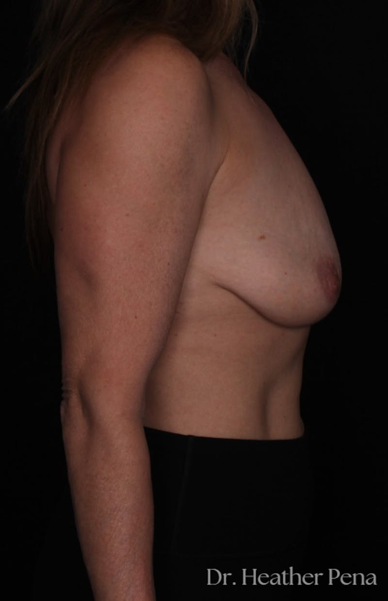 Breast Augmentation with Lift Before & After Gallery - Patient 310290 - Image 3