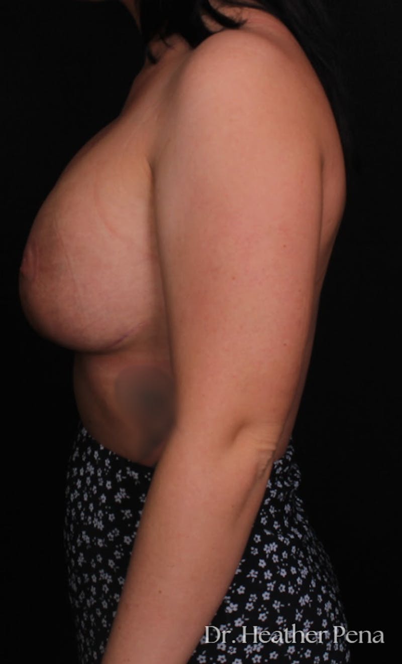 Breast Lift with Implant Exchange Before & After Gallery - Patient 387362 - Image 4