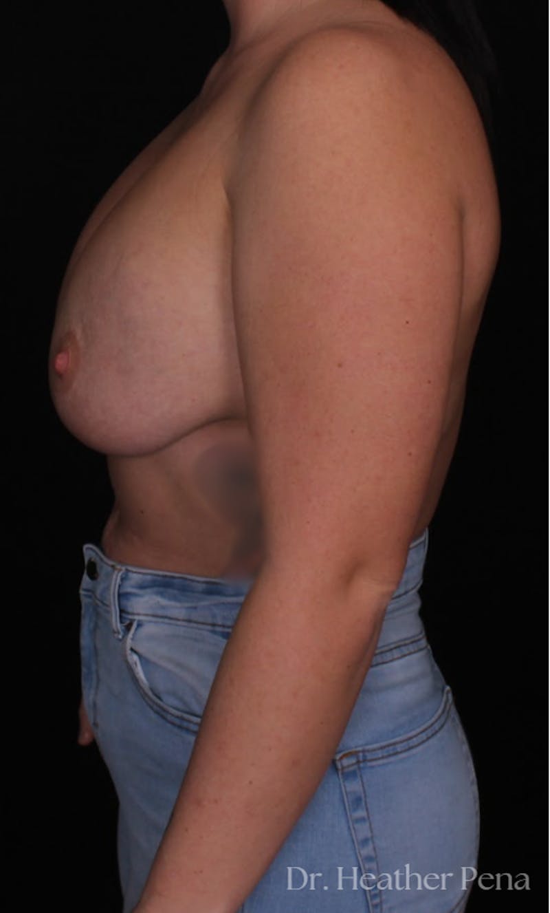 Breast Lift with Implant Exchange Before & After Gallery - Patient 387362 - Image 3