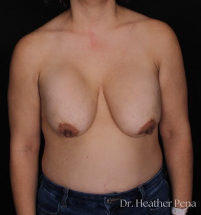 Breast Lift with Fat Grafting Before & After Gallery - Patient 710268 - Image 1