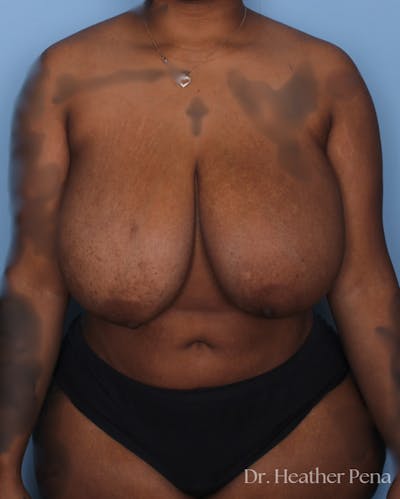 Breast Reduction Before & After Gallery - Patient 429249 - Image 1