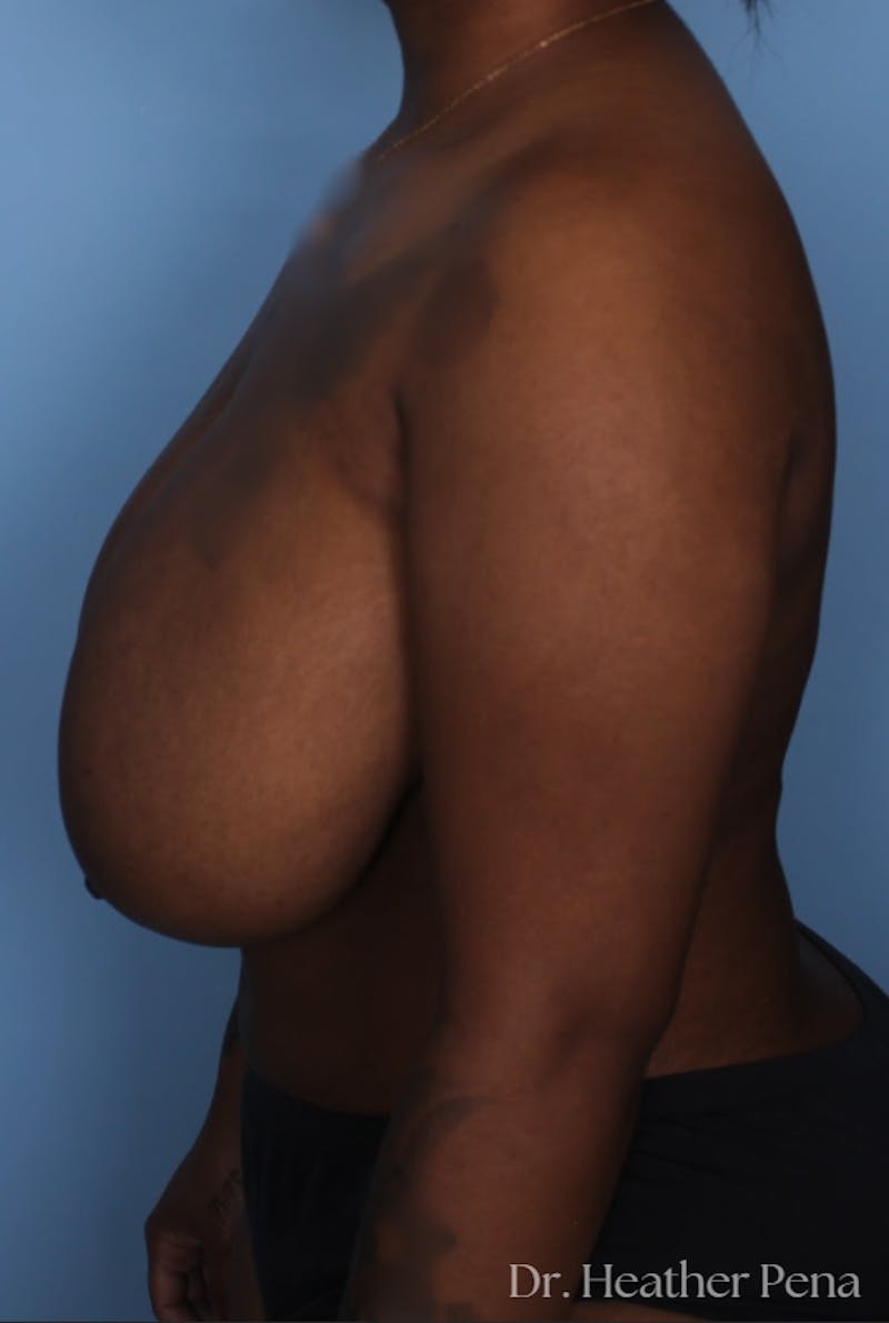 Breast Reduction Before & After Gallery - Patient 429249 - Image 3