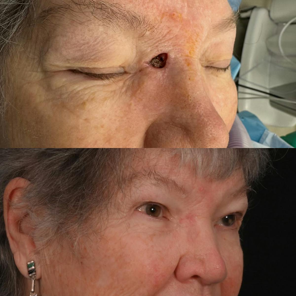 Mohs Facial Reconstruction  Before & After Gallery - Patient 968617 - Image 2