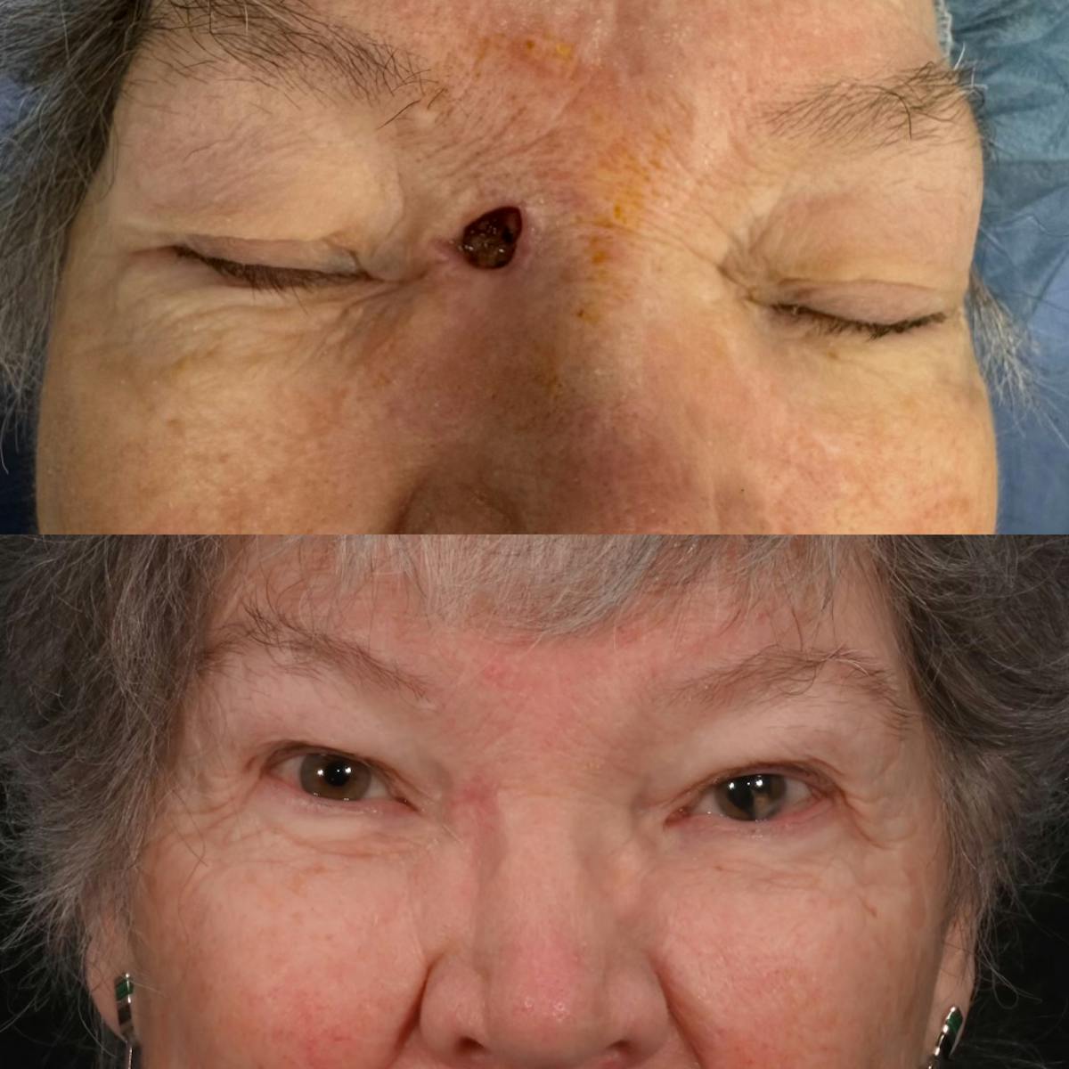 Mohs Facial Reconstruction  Before & After Gallery - Patient 968617 - Image 1