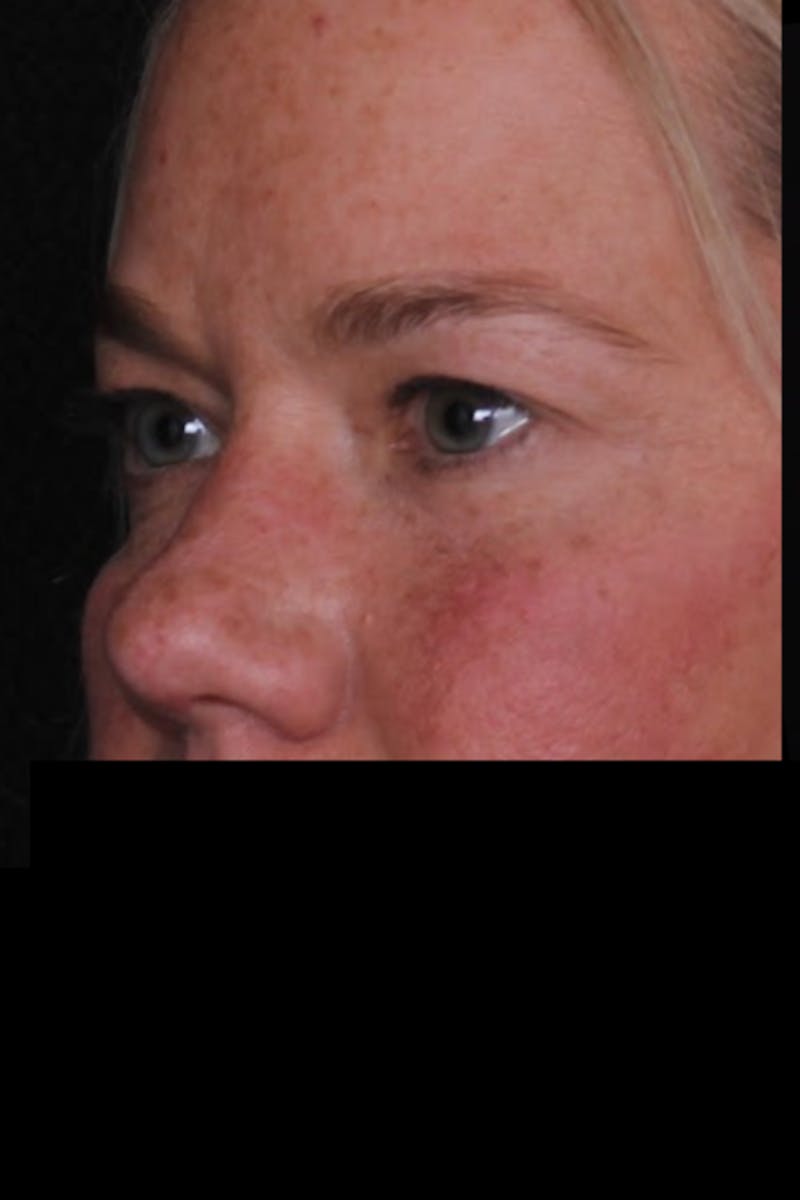 Blepharoplasty Before & After Gallery - Patient 196116 - Image 3