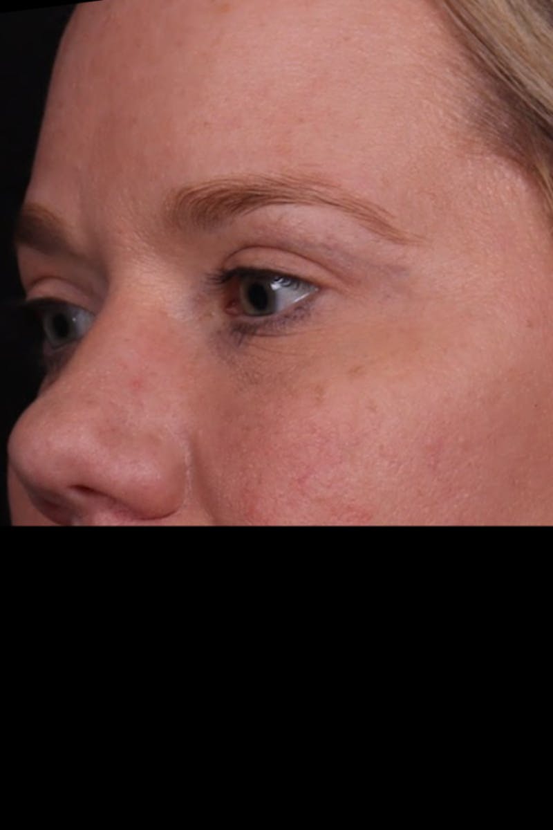 Blepharoplasty Before & After Gallery - Patient 196116 - Image 4