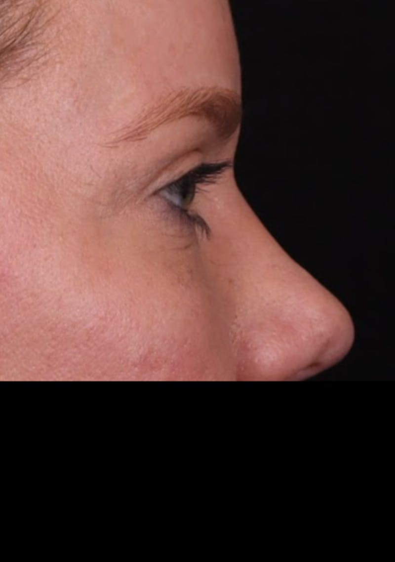 Blepharoplasty Before & After Gallery - Patient 196116 - Image 8