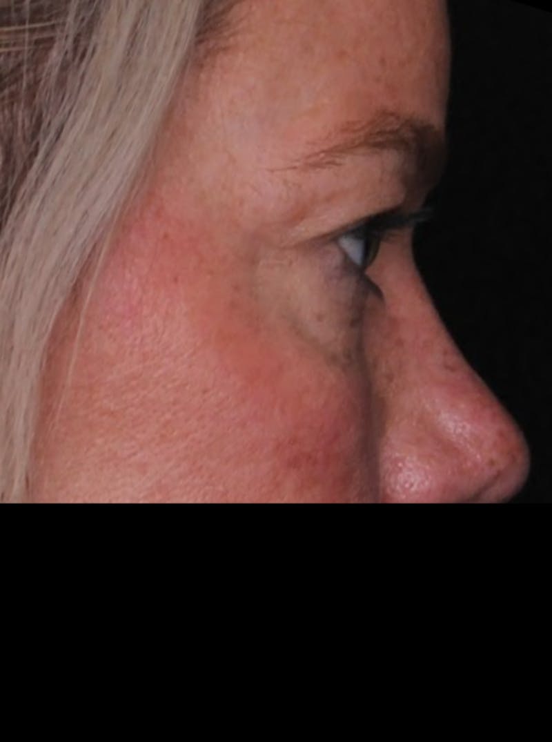 Blepharoplasty Before & After Gallery - Patient 196116 - Image 7