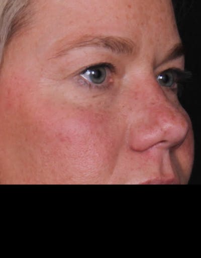 Blepharoplasty Before & After Gallery - Patient 196116 - Image 1