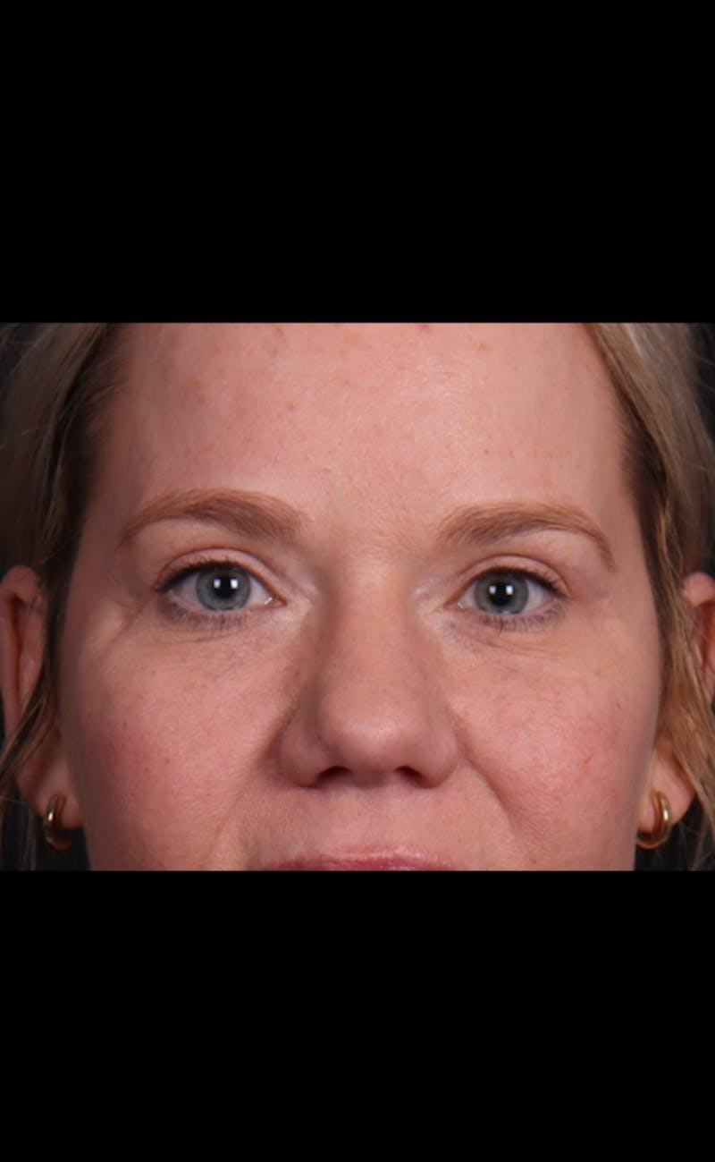 Blepharoplasty Before & After Gallery - Patient 196116 - Image 6