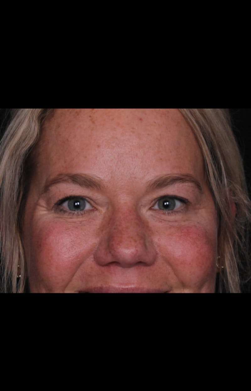Blepharoplasty Before & After Gallery - Patient 196116 - Image 5