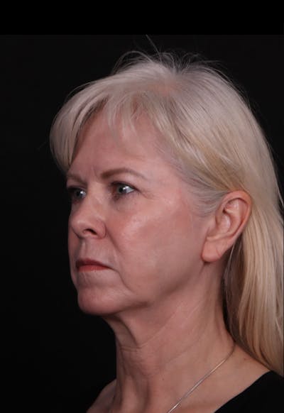 Face & Neck Lift Before & After Gallery - Patient 192293 - Image 1