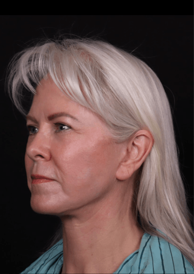Face & Neck Lift Before & After Gallery - Patient 192293 - Image 2