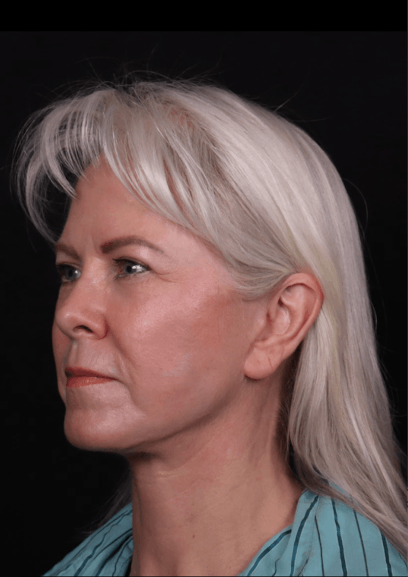 Face & Neck Lift Before & After Gallery - Patient 192293 - Image 2