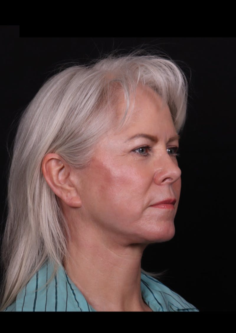 Face & Neck Lift Before & After Gallery - Patient 192293 - Image 4