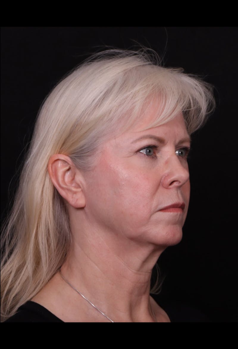 Face & Neck Lift Before & After Gallery - Patient 192293 - Image 3
