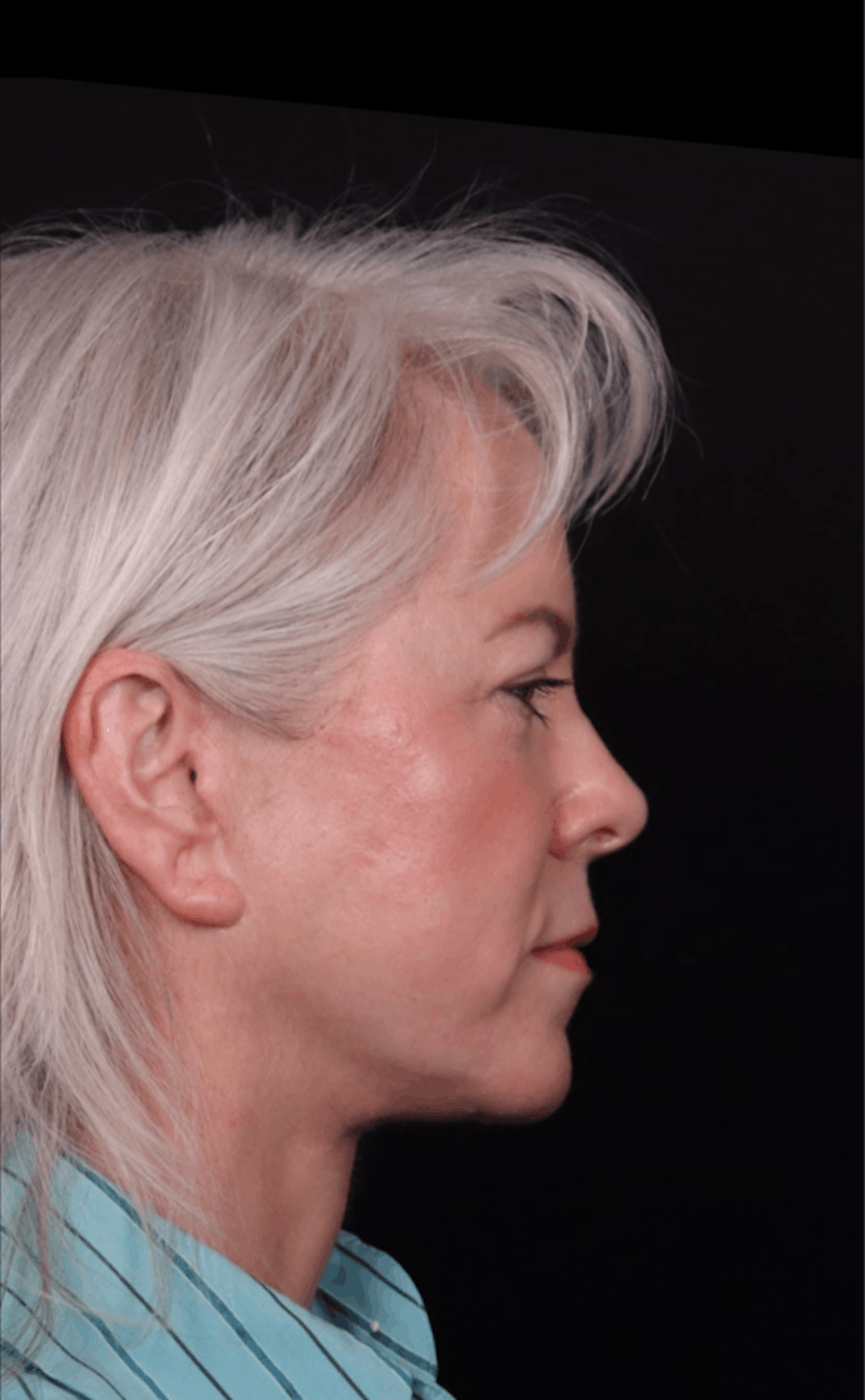 Face & Neck Lift Before & After Gallery - Patient 192293 - Image 6
