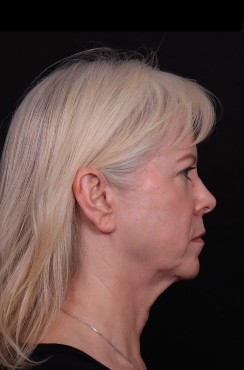 Face & Neck Lift Before & After Gallery - Patient 192293 - Image 5