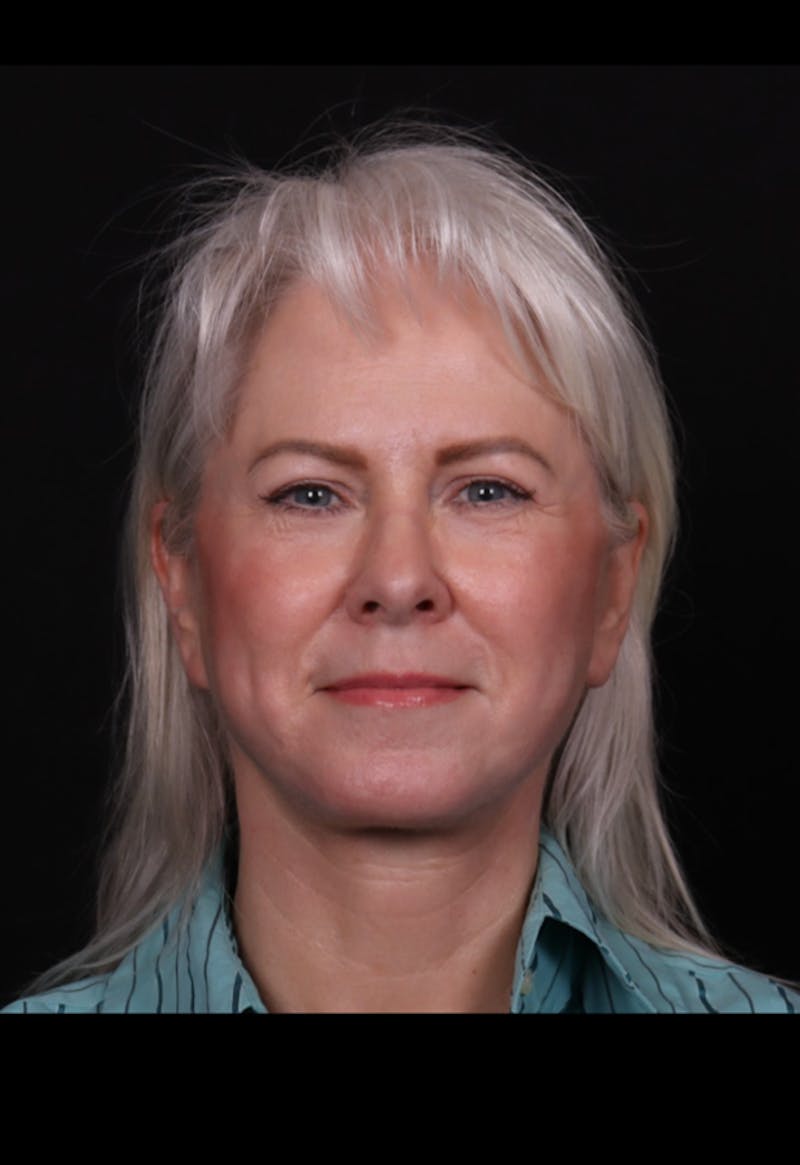 Face & Neck Lift Before & After Gallery - Patient 192293 - Image 8