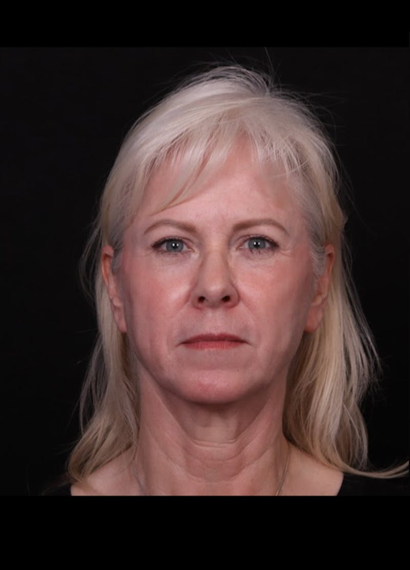 Face & Neck Lift Before & After Gallery - Patient 192293 - Image 7