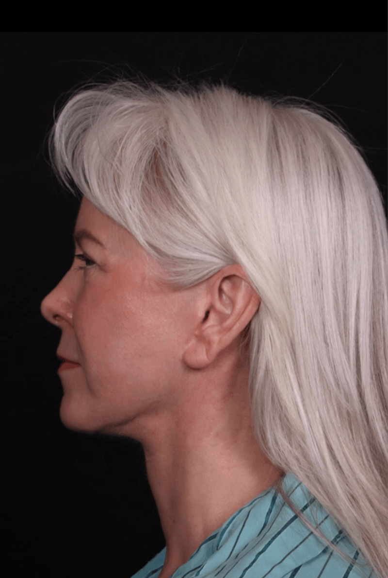Face & Neck Lift Before & After Gallery - Patient 192293 - Image 10
