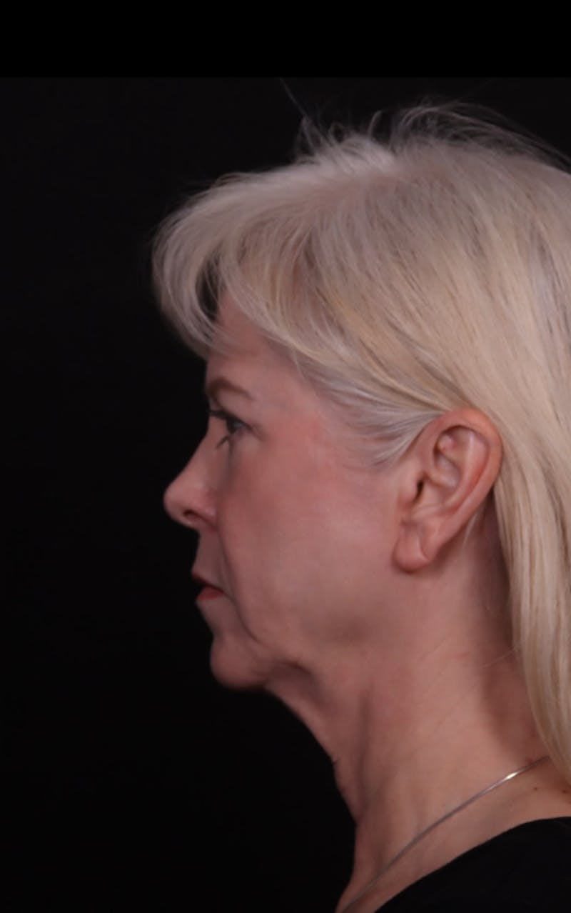 Face & Neck Lift Before & After Gallery - Patient 192293 - Image 9