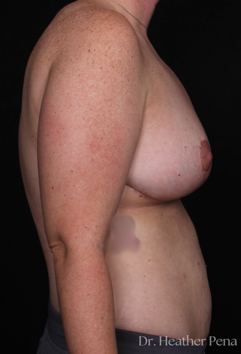 Breast Reduction Before & After Gallery - Patient 333415 - Image 4