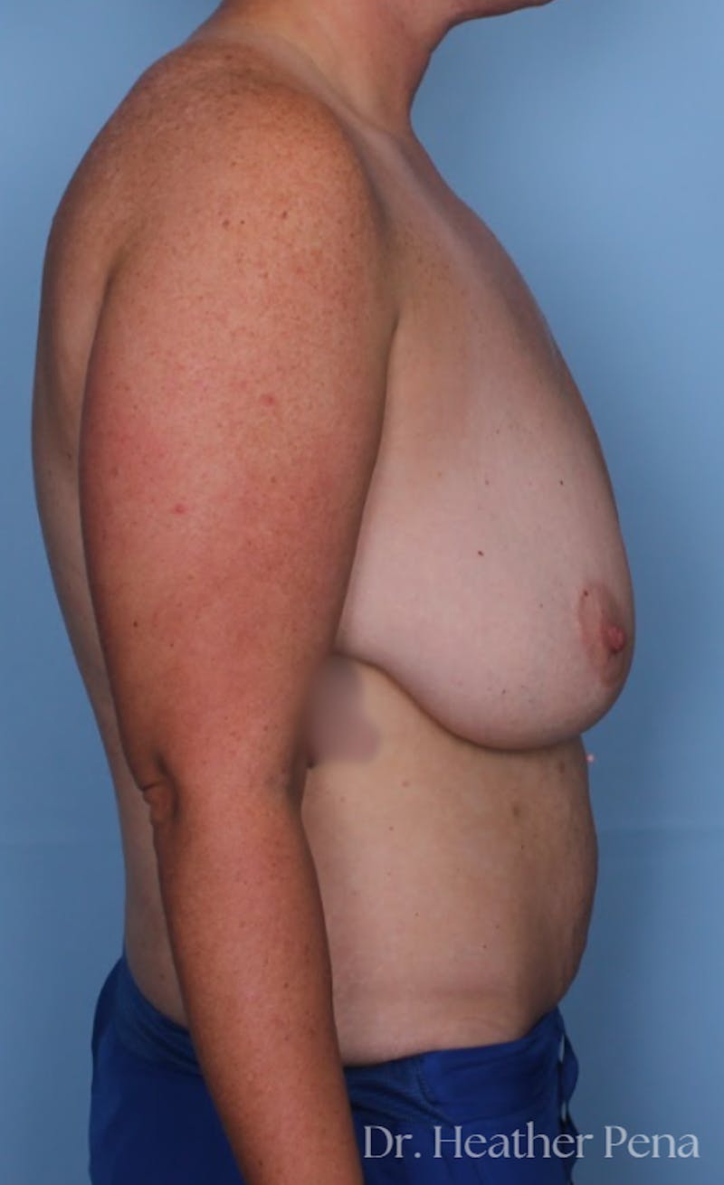 Breast Reduction Before & After Gallery - Patient 333415 - Image 3
