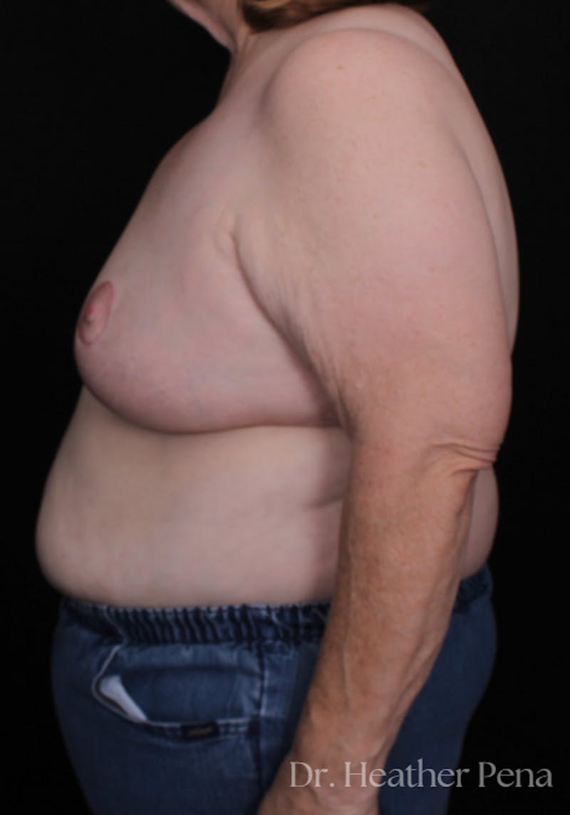 Breast Reduction Before & After Gallery - Patient 519122 - Image 4