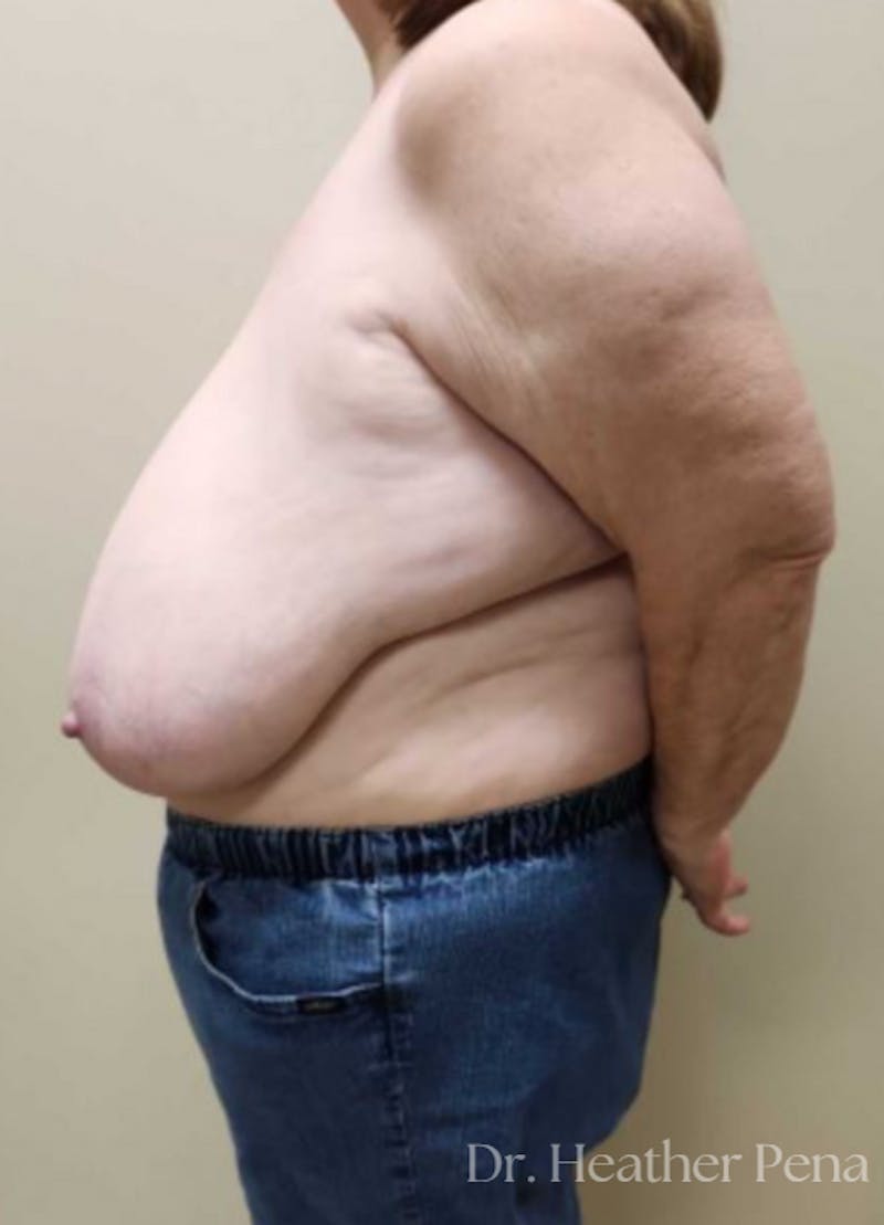 Breast Reduction Before & After Gallery - Patient 519122 - Image 3