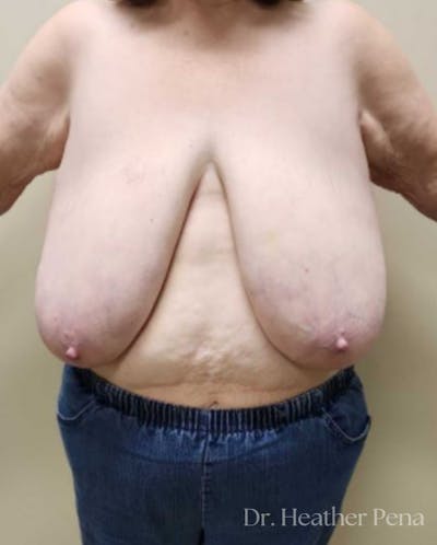 Breast Reduction Before & After Gallery - Patient 519122 - Image 1