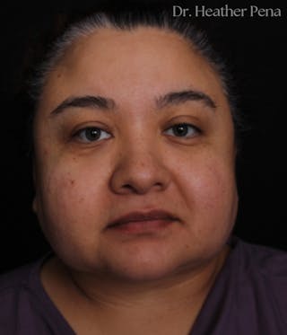 Liposuction Before & After Gallery - Patient 414649 - Image 2