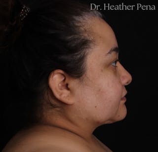 Liposuction Before & After Gallery - Patient 414649 - Image 4