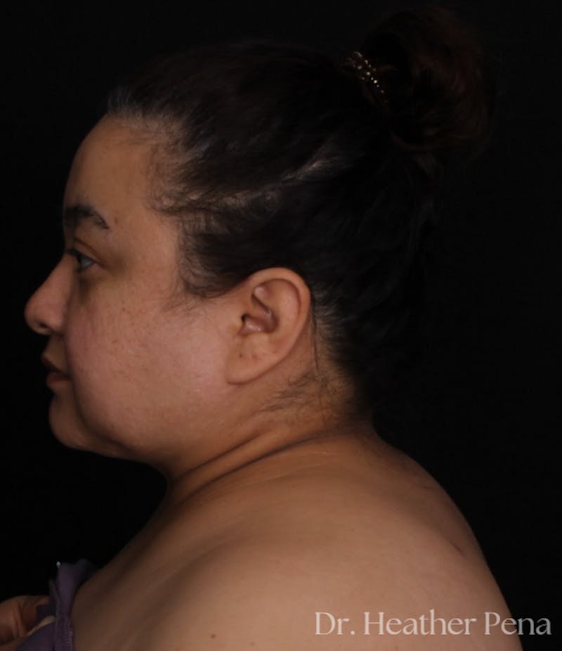 Liposuction Before & After Gallery - Patient 414649 - Image 6