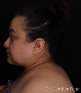 Liposuction Before & After Gallery - Patient 414649 - Image 6