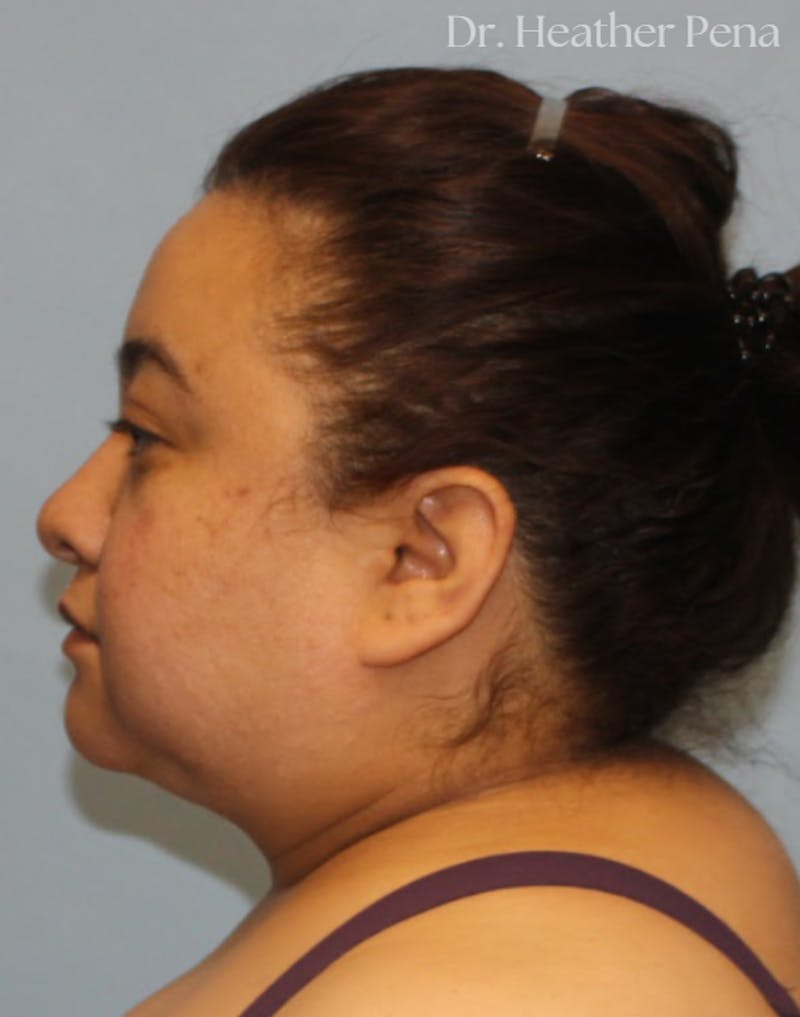 Liposuction Before & After Gallery - Patient 414649 - Image 5
