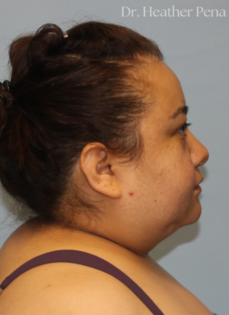 Liposuction Before & After Gallery - Patient 414649 - Image 3
