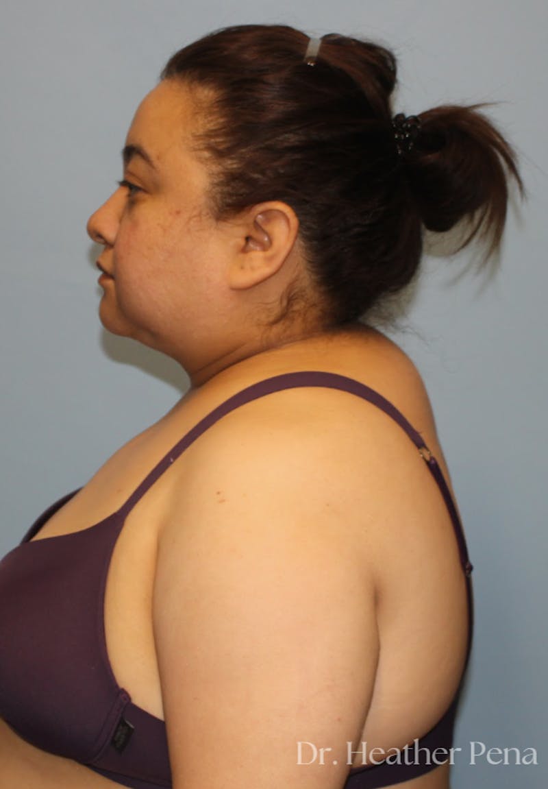 Liposuction Before & After Gallery - Patient 414649 - Image 7