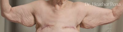 Arm Lift Before & After Gallery - Patient 536574 - Image 1