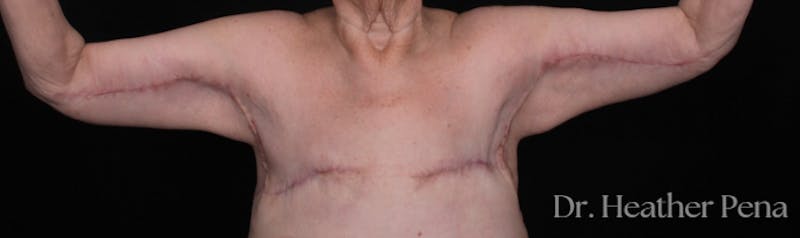 Arm Lift Before & After Gallery - Patient 536574 - Image 2