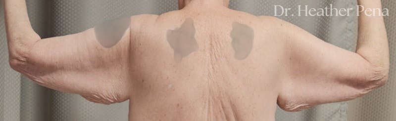 Arm Lift Before & After Gallery - Patient 536574 - Image 3